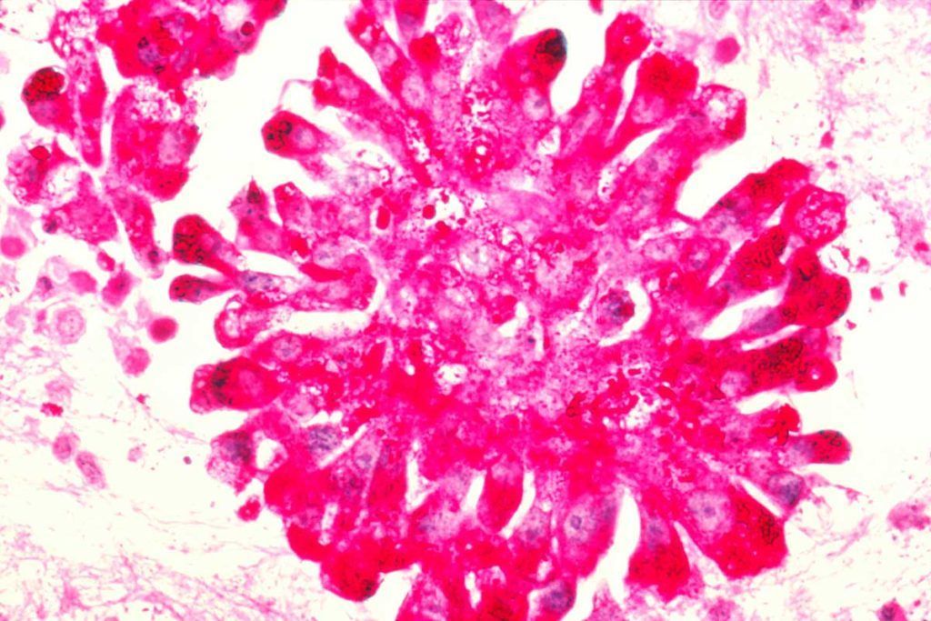 Avances en el tratamiento del sarcoma de Ewing