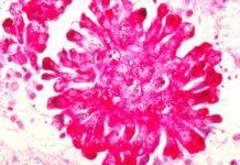 Avances en el tratamiento del sarcoma de Ewing Avances en el tratamiento del sarcoma de Ewing