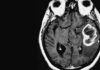 Innovador hidrogel inyectable frente al glioblastoma multiforme Innovador hidrogel inyectable frente al glioblastoma multiforme
