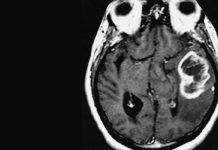 Innovador hidrogel inyectable frente al glioblastoma multiforme Innovador hidrogel inyectable frente al glioblastoma multiforme