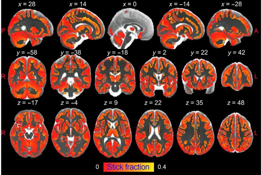 La inflamación cerebral afecta al sueño y al riesgo de Alzheimer