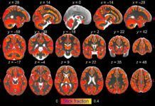 La inflamación cerebral afecta al sueño y al riesgo de Alzheimer La inflamación cerebral afecta al sueño y al riesgo de Alzheimer