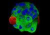 Cáncer de mama: detectan signos nanométricos con biopsia líquida Cáncer de mama: detectan signos nanométricos con biopsia líquida