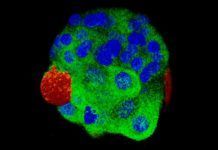 Cáncer de mama: detectan signos nanométricos con biopsia líquida Cáncer de mama: detectan signos nanométricos con biopsia líquida