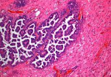 Avance para combatir la metástasis de ciertos cánceres Avance para combatir la metástasis de ciertos cánceres
