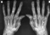 Artritis reumatoide: ¿Por qué no funcionan igual las terapias en pacientes con el mismo diagnóstico? Artritis reumatoide: ¿Por qué en pacientes con igual diagnóstico se obtienen respuestas distintas con las terapias actuales?