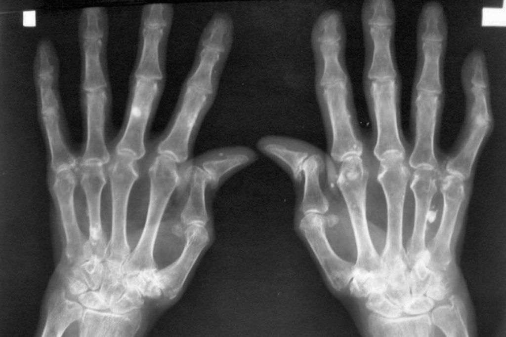 Artritis reumatoide: ¿Por qué en pacientes con igual diagnóstico se obtienen respuestas distintas con las terapias actuales?