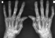 Artritis reumatoide: ¿Por qué no funcionan igual las terapias en pacientes con el mismo diagnóstico? Artritis reumatoide: ¿Por qué en pacientes con igual diagnóstico se obtienen respuestas distintas con las terapias actuales?