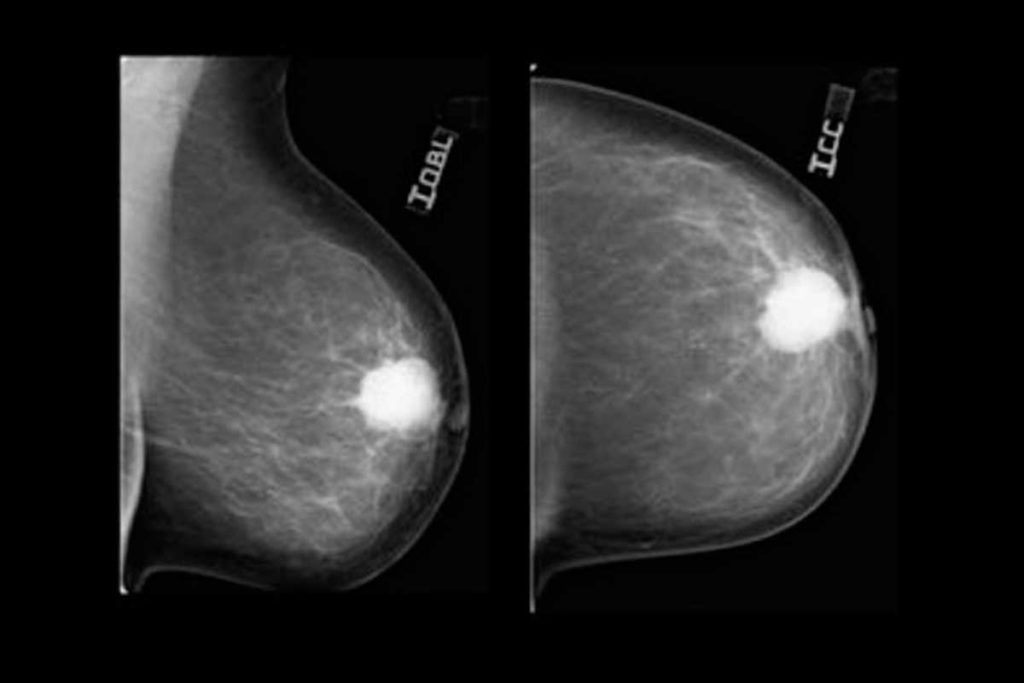 ¿Por qué algunas mujeres desarrollan cáncer de mama agresivo?