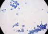 Cautela ante el anuncio de que han frenado el cáncer de páncreas en laboratorio Cautela ante el anuncio de que han frenado el cáncer de páncreas en laboratorio