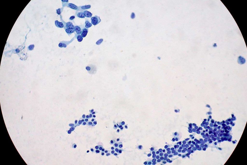Cautela ante el anuncio de que han frenado el cáncer de páncreas en laboratorio