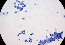 Cautela ante el anuncio de que han frenado el cáncer de páncreas en laboratorio Cautela ante el anuncio de que han frenado el cáncer de páncreas en laboratorio
