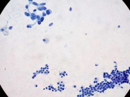 Nueva estrategia contra el cáncer de páncreas Nueva estrategia contra el cáncer de páncreas