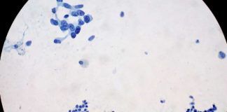 Nueva estrategia contra el cáncer de páncreas Nueva estrategia contra el cáncer de páncreas