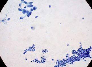 Nueva estrategia contra el cáncer de páncreas Nueva estrategia contra el cáncer de páncreas