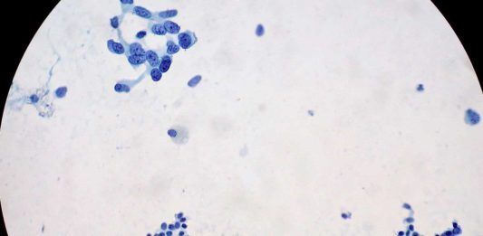 Nueva estrategia contra el cáncer de páncreas Nueva estrategia contra el cáncer de páncreas