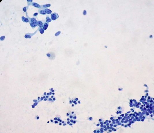 Nueva estrategia contra el cáncer de páncreas Nueva estrategia contra el cáncer de páncreas