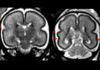 Beber alcohol en el embarazo cambia la forma del cerebro del feto Beber alcohol en el embarazo cambia la forma del cerebro del feto