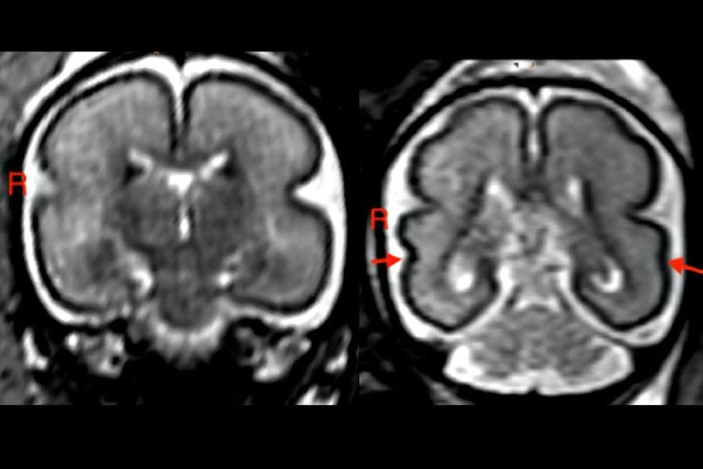 Beber alcohol en el embarazo cambia la forma del cerebro del feto