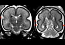 Beber alcohol en el embarazo cambia la forma del cerebro del feto Beber alcohol en el embarazo cambia la forma del cerebro del feto