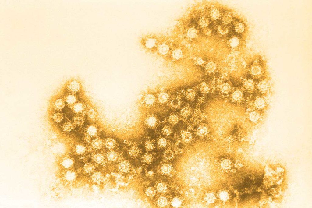 Relación entre infección por enterovirus y diabetes tipo 1