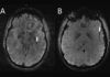Las migrañas producen cambios en el cerebro Las migrañas producen cambios en el cerebro
