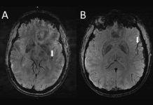 Las migrañas producen cambios en el cerebro Las migrañas producen cambios en el cerebro