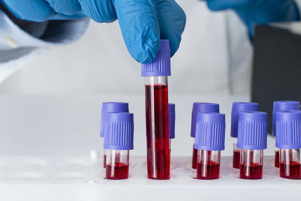 El cáncer de páncreas se puede diagnosticar tres años antes de que aparezca