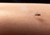 Los mosquitos nos transfieren bacterias al posarse sobre la piel Los mosquitos nos transfieren bacterias al posarse sobre la piel