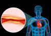Nuevo método para visualizar placas de aterosclerosis Nuevo método para visualizar placas de aterosclerosis