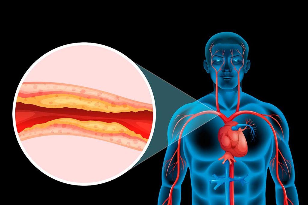 Nuevo método para visualizar placas de aterosclerosis