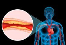 Nuevo método para visualizar placas de aterosclerosis Nuevo método para visualizar placas de aterosclerosis