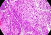 Innovador modelo que identifica el alto riesgo de cáncer de endometrio Innovador modelo que identifica el alto riesgo de cáncer de endometrio
