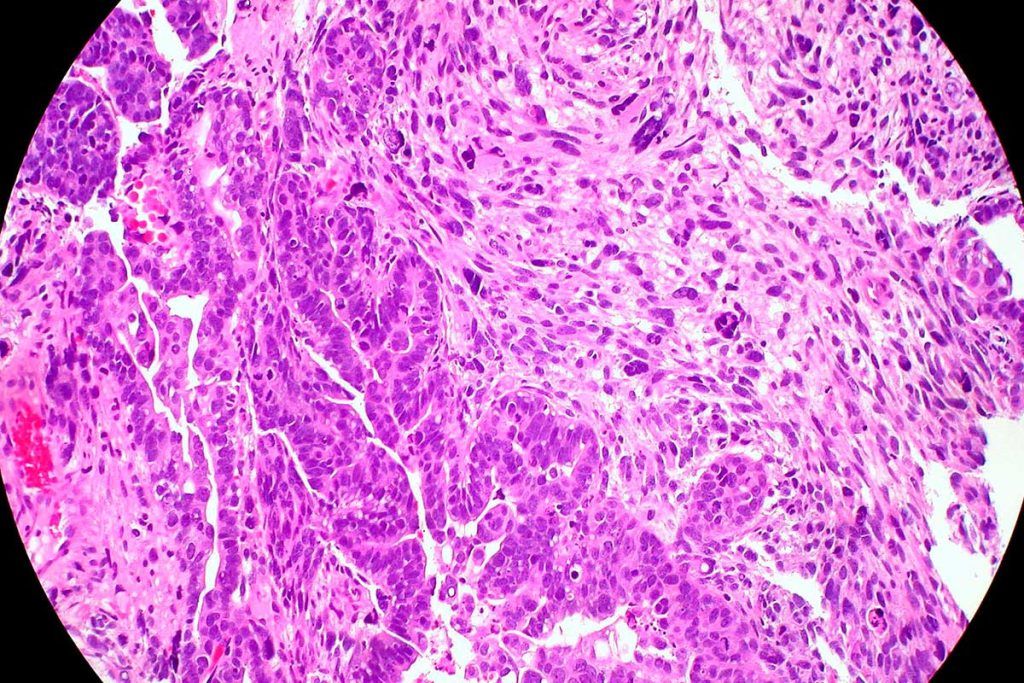 Innovador modelo que identifica el alto riesgo de cáncer de endometrio