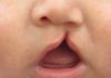 Hallan nuevos genes vinculados al labio leporino Hallan nuevos genes vinculados al labio leporino