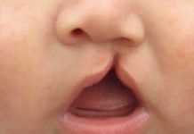 Hallan nuevos genes vinculados al labio leporino Hallan nuevos genes vinculados al labio leporino
