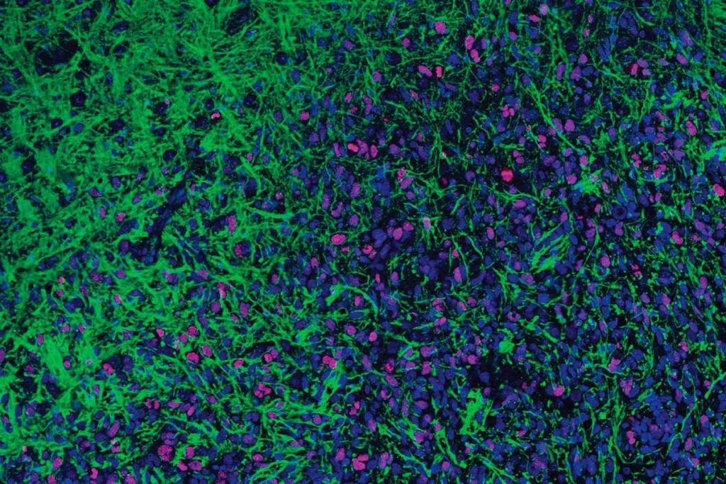 Innovador tratamiento experimental contra un cáncer pediátrico