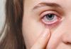 Herpes ocular: descubren una proteína clave en las reinfecciones Herpes ocular: descubren una proteína clave en las reinfecciones