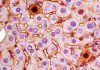Identifican subtipos de cáncer de hígado con edición de genes Identifican subtipos de cáncer con edición de genes
