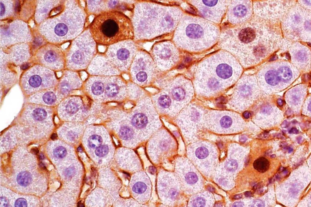 Identifican subtipos de cáncer con edición de genes