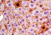 Identifican subtipos de cáncer de hígado con edición de genes Identifican subtipos de cáncer con edición de genes