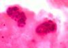Arrojan luz en la metástasis del cáncer de mama Arrojan luz en la metástasis del cáncer de mama