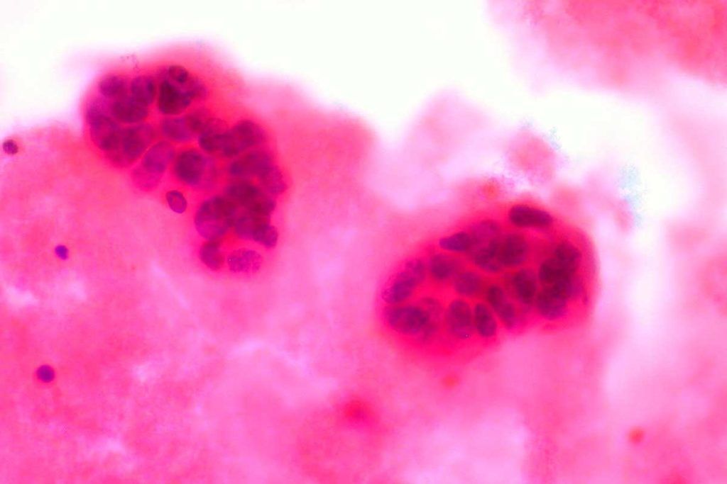 Arrojan luz en la metástasis del cáncer de mama