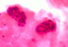 Arrojan luz en la metástasis del cáncer de mama Arrojan luz en la metástasis del cáncer de mama