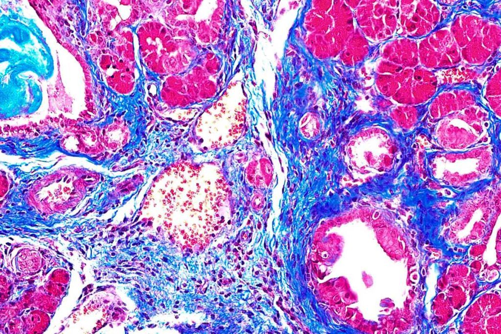 Radiación junto con inmunoterapia, eficaz contra el cáncer de páncreas