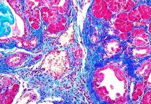 Radiación junto con inmunoterapia, eficaz contra el cáncer de páncreas Radiación junto con inmunoterapia, eficaz contra el cáncer de páncreas