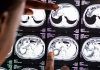 Ingeniería génica contra melanoma con metástasis cerebral Ingeniería génica contra melanoma con metástasis cerebral