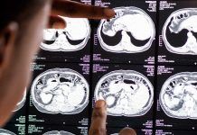 Ingeniería génica contra melanoma con metástasis cerebral Ingeniería génica contra melanoma con metástasis cerebral