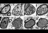 Desvelan mecanismos moleculares de la esclerosis múltiple Desvelan mecanismos moleculares de la esclerosis múltiple