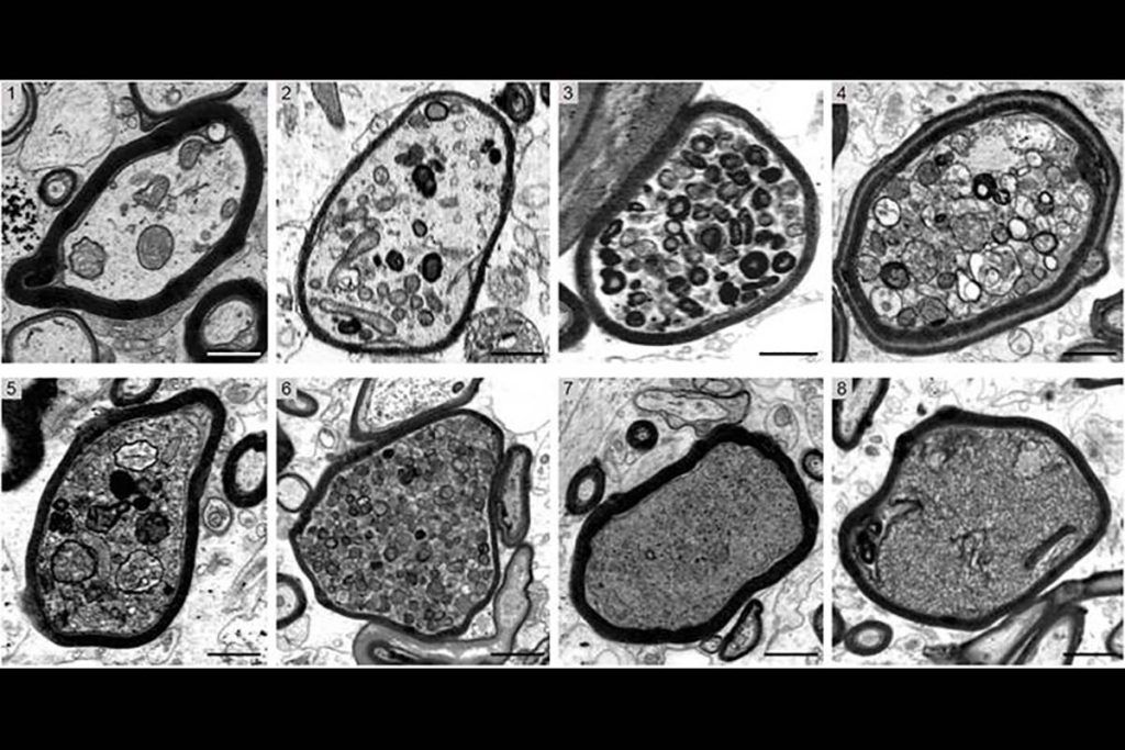 Desvelan mecanismos moleculares de la esclerosis múltiple